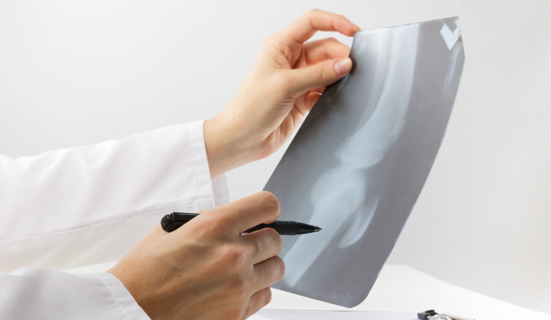 3 Treatments to Try Before Knee Replacement