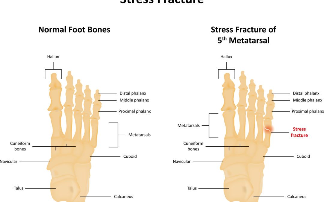 Why Are Stress Fractures So Common In Athletes? High Mountain Orthopedics
