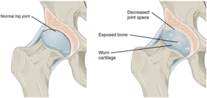 Comparison of Normal Hip with Arthritic Hip