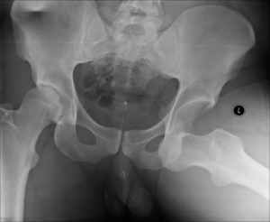 Illustration of Hip Dislocation 