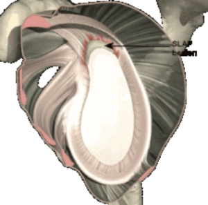 shoulder labrum tear