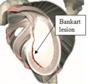 bankart tear