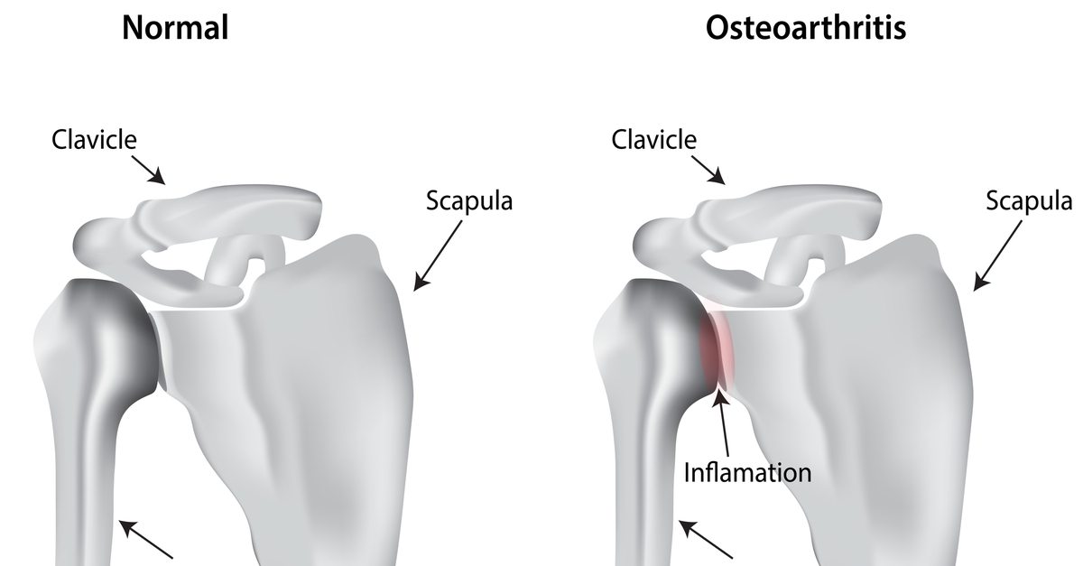 Corticosteroids Injections for Shoulder Arthritis Wayne, NJ High