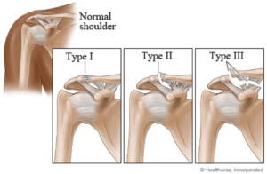 shoulder seperation