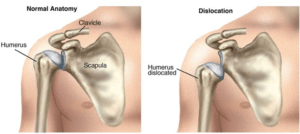 shoulder dislocation