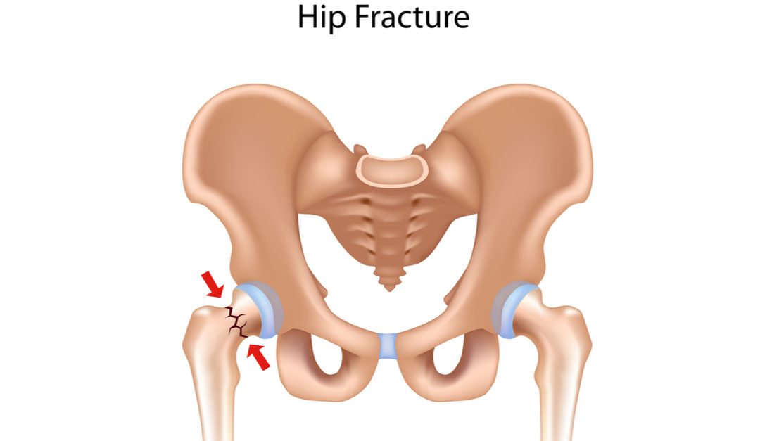 Osteoporosis-Related Hip Fractures: Everything You Need to Know