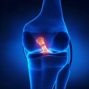 Representation of X-Ray of ACL Tear